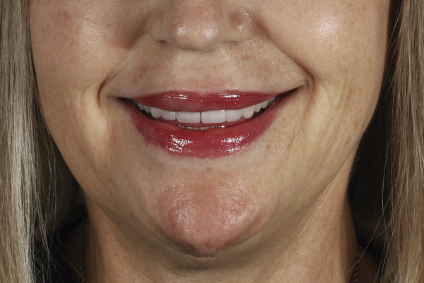 Dental aesthetics in Benidorm before and after