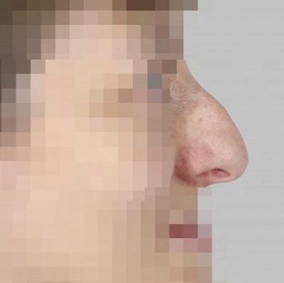 rhinoplasty in Spain before and after