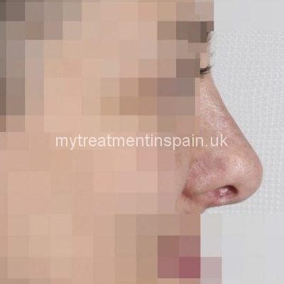 rhinoplasty in Spain before and after