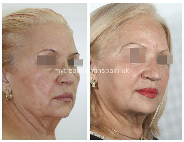rejuvenation peeling before and after 1 in Benidorm, Spain