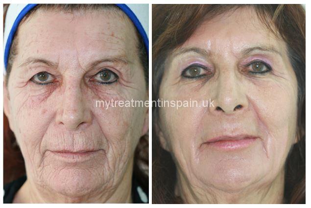 rejuvenation peeling before and after 1 in Benidorm, Spain