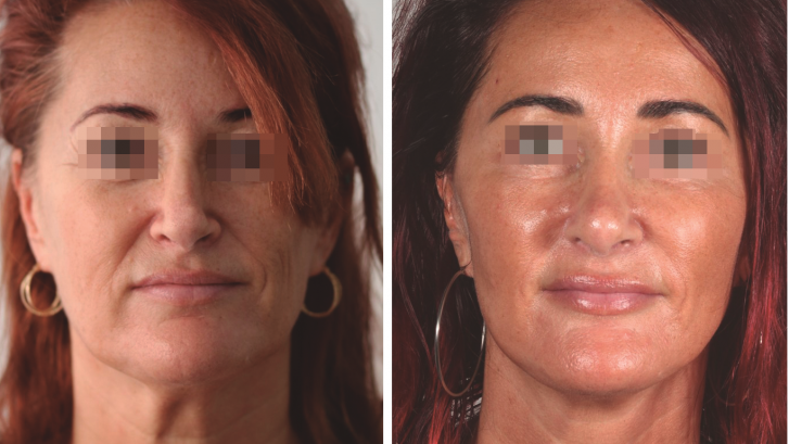 FACIAL LIFTING - My in Your doctors of face, mouth and neck