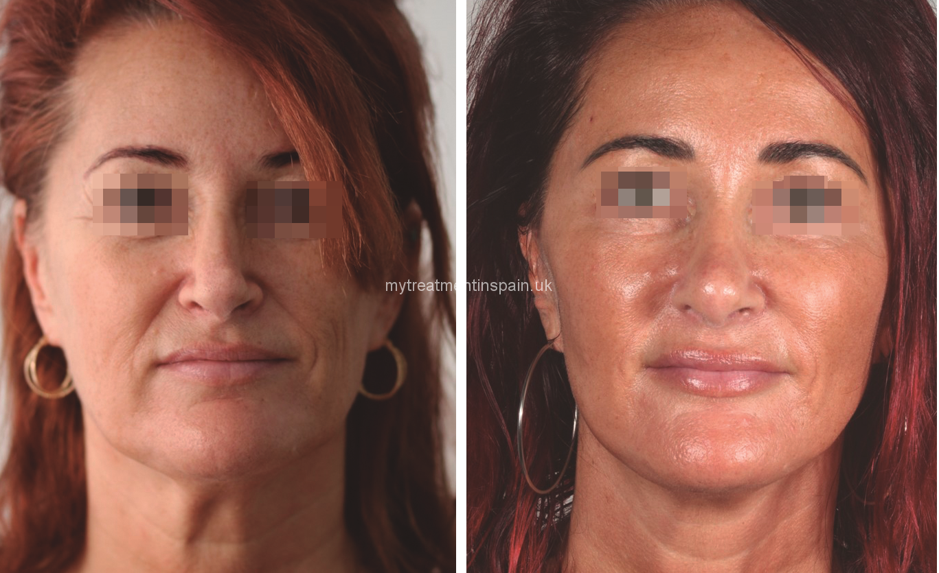 FACIAL LIFTING BEFORE AND AFTER