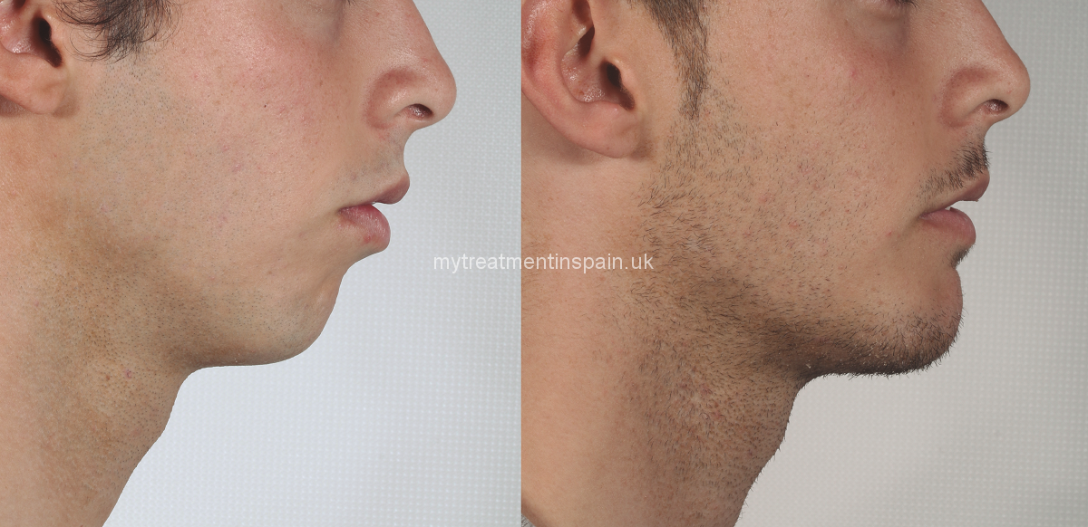 Chin surgery, mentoplasty or mandibular surgery in Spain. Plastic cases before and after