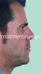 combined treatment: rhinoplasty and mentoplasty